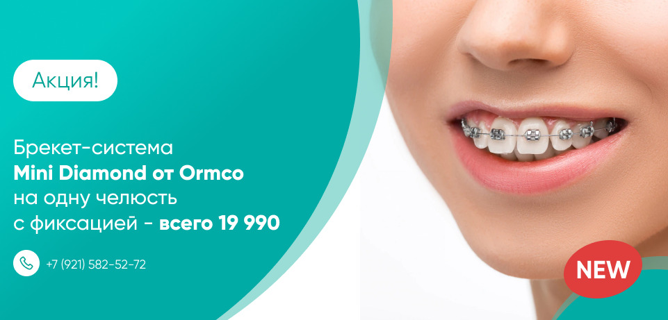 Брекет-система Мini Diamond от Ormco